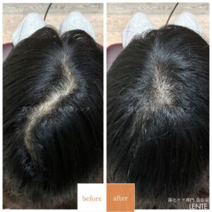 薄毛の悩み「見せたくない、話ずらい」問題