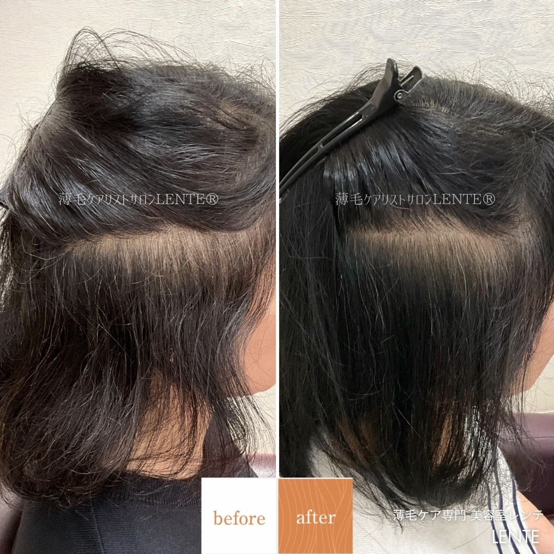 【女性の薄毛】サイド（耳まわり）の薄毛が増えている理由｜4ヶ月の変化実例つき